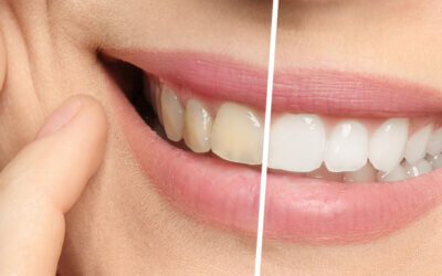 How Long Does Teeth Whitening Last?