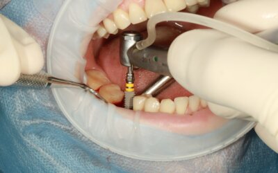 6 Major Benefits of Dental Implants