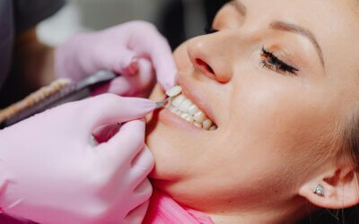 Top-Quality Veneers in Columbia, SC: Transform Your Smile Today